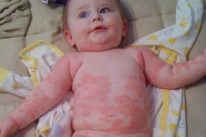 Kredit:http://www.hergamut.com/milk-allergy-symptoms-in-babies/